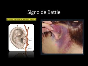 Signo de Battle