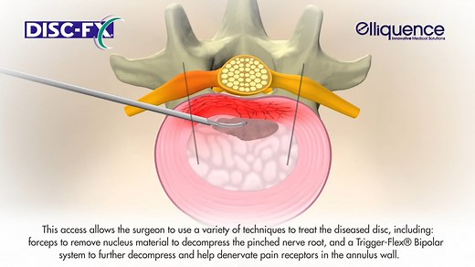 Disc-FX Patient Animation