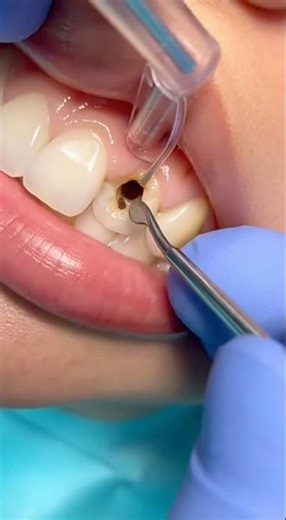 Teeth cleaning videos tutorial