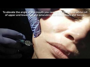 Dermal Filler Injections || Temple and mouth corner || Trends and Innovations in Aesthetic Medicine
