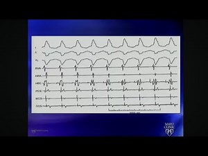 Intracardiac EP Tracings