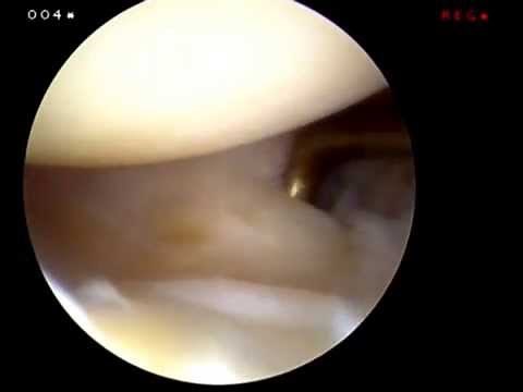 TFCC Hook Test of the wrist