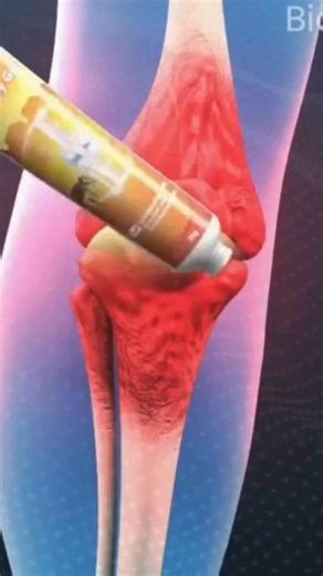 👉 A new frontier in the fight against joint pain, stiffness, and cartilage wear: a targeted-action cream that delivers immediate relief to knees, back, shoulders, hips, and hands — with no drugs, no irritation, and no complications. With just one simple application, the advanced OsteoFlex formula, enriched with analgesic, anti-inflammatory, and regenerative active ingredients, penetrates quickly into the tissues, improves microcirculation, reduces inflammation, and supports joint mobility — at 