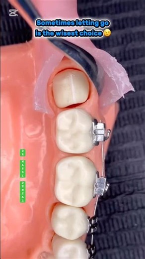 WISDOM TEETH EXTRACTION 😬🦷