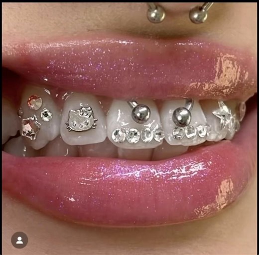 Tooth Gems: The Trendy Dental Accessory