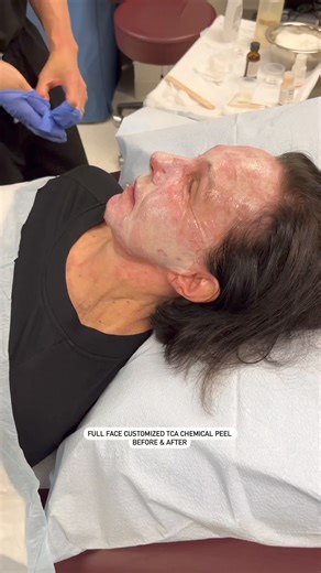 A full face customized TCA chemical peel offers several benefits for skin rejuvenation and treatment including: - Reduction of fine lines and wrinkles - Improvement in skin texture and tone - Pigmentation correction - Enhanced absorption of skincare products It's important to have these treatments performed by a qualified skincare professional to ensure safety and effectiveness Here at The Williams Center, our specialized team performs numerous full face customized TCA chemical peels that have e