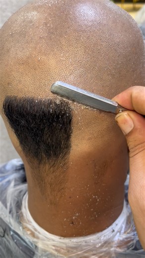 head shave for dandruff: ultimate quick fix for flaky scalp #balding