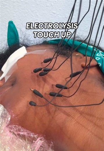 Effective Electrolysis Solutions for PCOS Hair Removal