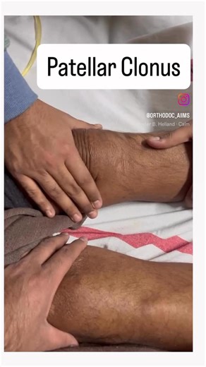 A young Orthopod on Instagram: "Patellar Clonus is seen in - . . . . Patellar clonus is an abnormal, rhythmic contraction of the quadriceps muscle in response to sudden stretch of the patellar tendon. Its presence indicates hyperreflexia due to a loss of descending inhibitory control, a hallmark of upper motor neuron (UMN) lesions. #InpatientNeurology #BedsideExam #UMNLesion #StrokeAssessment #SpinalCordInjury #NeurologicalExam #ClinicalMedicine #ICUAssessment #MBBS #NEETPG #MedicalTraining #War