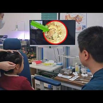 子どもの耳掃除ASMR｜たまった耳垢を丁寧に除去する満足動画 EP.16