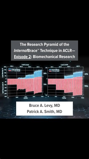 Arthrex Medical Education on Instagram: "In the second episode of this three-part series, Bruce A. Levy, MD, and Patrick A. Smith, MD, explore the peer-reviewed, published biomechanical research evaluating the concept of load sharing and how the InternalBrace™ technique impacts displacement, load, and stiffness for different graft sizes and types, including: ▪️ Biomechanical features of FiberTape® suture ▪️ The importance of independent fixation to create a load-sharing construct to avoid stress