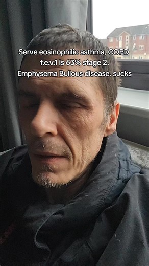 Understanding Eosinophilic Asthma and Emphysema