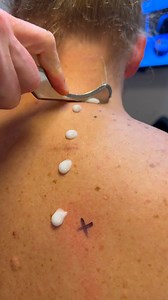 26K views |  Instrument Assisted Soft Tissue Mobilization (IASTM) helps break up scar tissue and fascial restrictions using specially designed tools. This technique promotes better circulation, restores mobility, and speeds up recovery from overuse or injury. #IASTM #SoftTissueTherapy #ChicagoChiropractic #Chiropractor#drkyleross | Dr_kyleross | Facebook