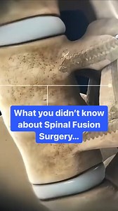 9.3K views · 26 reactions | Can we be honest about spinal fusion...