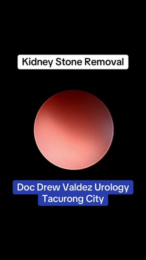 Kidney Stone Removal (Mini-PCNL) by Doc Drew Valdez Urology in Tacurong City