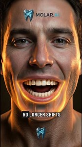 Implant supported dentures
