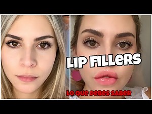 ÁCIDO HIALURÓNICO EN LOS LABIOS? *MI EXPERIENCIA CON LOS FILLERS