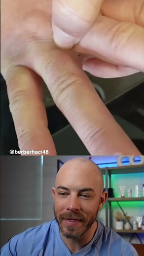 Fascinating hair splinter removal🤯 #hairsplinter #dermreacts #doctorreacts