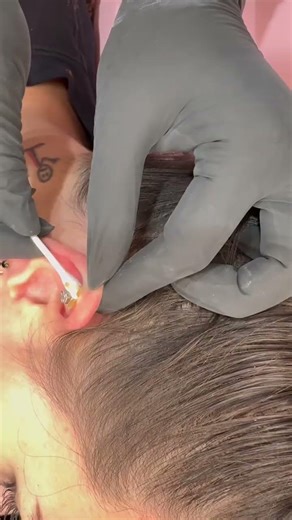 Helix Piercing Bump Care | Cartilage Piercing Healing Routine 💧