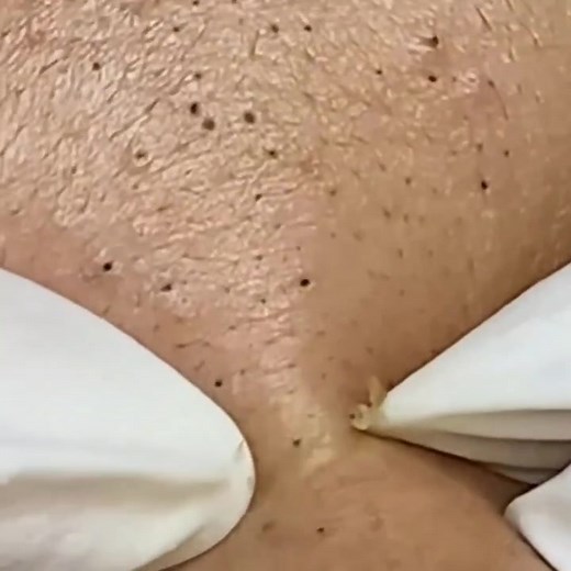 Blackhead Removal ASMR | Relaxing Extraction Videos