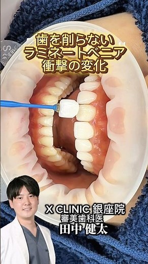 話題の歯を一切削らないラミネートベニア治療🦷💎 #審美歯科 #セラミック #ラミネートベニア
