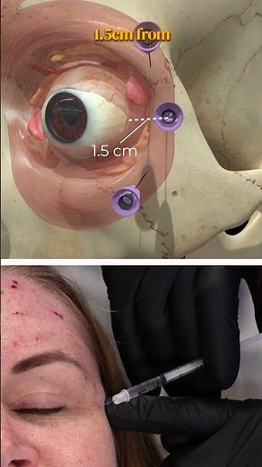 How to: Botox for crow's feet