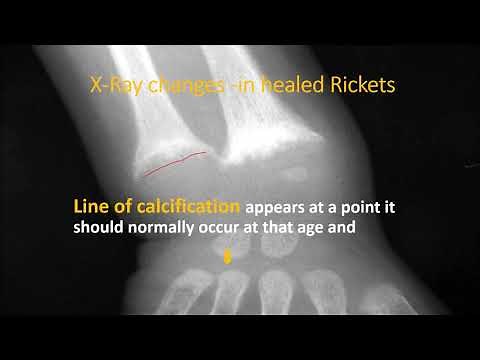 X-Ray wrist in rickets (Part 2/3) | Rickets | Pediatrics