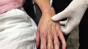 Radiesse: Hand Volumization