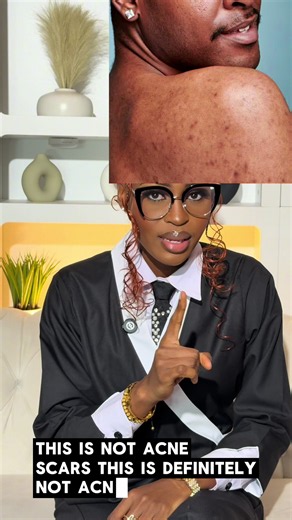 PIH vs Acne Scars: How to Tell the Difference and Treat Dark Spots