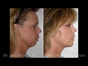 Genioplasty Versus Chin Implant