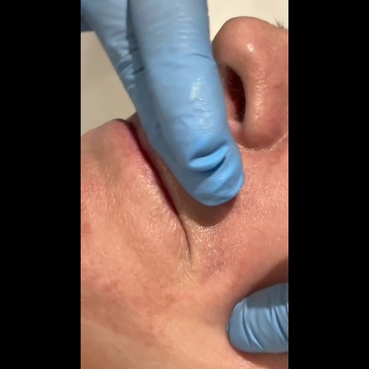 🌟 **Revitalize Your Skin with PRX T Bio Stimulator at Tracey Bell Clinic!** ✨ Say goodbye to dull and aging skin with our cutting-edge PRX T Bio Stimulator treatment. Unveil a radiant and youthful complexion that sparkles with vitality! 🌺 **Benefits of PRX T Bio Stimulator Treatment:** - Boost in skin elasticity - Collagen genesis for firm and supple skin - Rejuvenated and refreshed skin texture 👩‍⚕️ Trust our experts at Tracey Bell Clinic to elevate your skincare routine and redefine your be