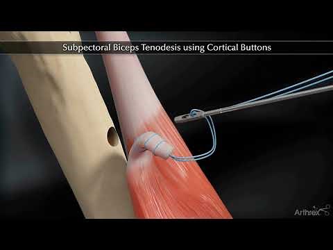Subpectoral Biceps Tenodesis Using Cortical Buttons