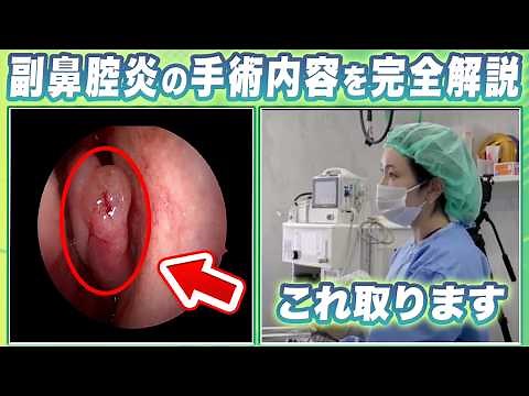 【手術前必見】副鼻腔炎の手術内容を完全解説【日帰り手術】
