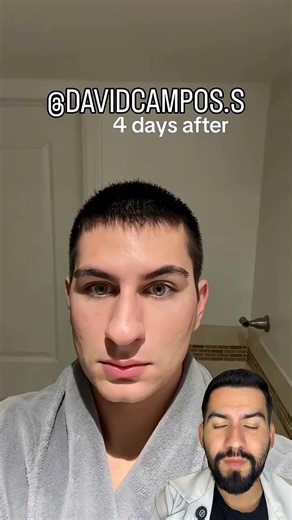 How Botox Really Works