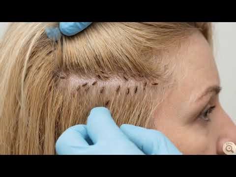 Head Lice Up Close | ASMR