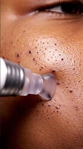 Deep Root Blackhead Removal