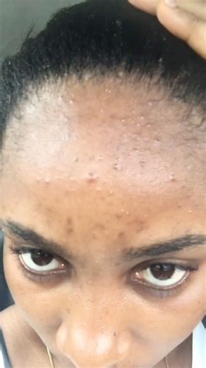 Dealing with acne and hyperpigmentation #skincarelover