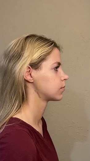 Total Joint Replacement of TMJs + le fort 1 piece + genioplasty for ICR