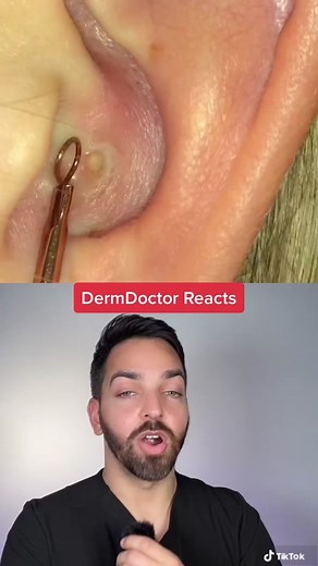 One of the best #dermdoctor #dermatologist #pimplepopper | ear pimple