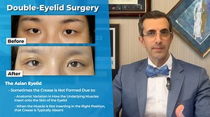 In this video, Dr. Basel A. Sharaf discusses, “Less Is Better: Full-Incision Double-Eyelid Blepharoplasty with Rapid Recovery,” by Zhang, Li, Lei, et al, which appears in the August 2024 issue of Plastic and Reconstructive Surgery, Volume 154 Issue 2. Read it here: https://bit.ly/EyelidCrease | Plastic and Reconstructive Surgery