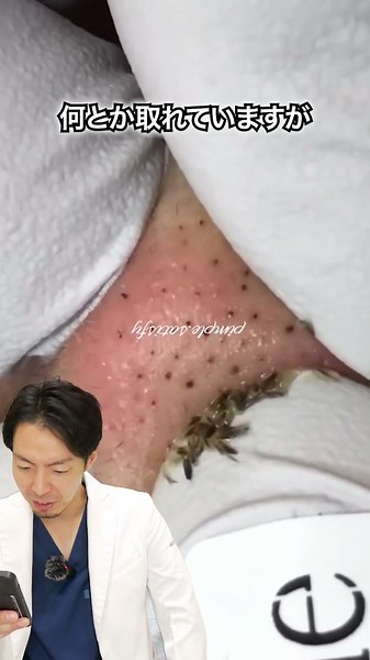 頑固な鼻の黒ずみを撃退！黒い角栓をにゅるにゅる除去 #shorts
