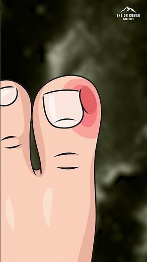 The Real Cause Of Ingrown Toenails