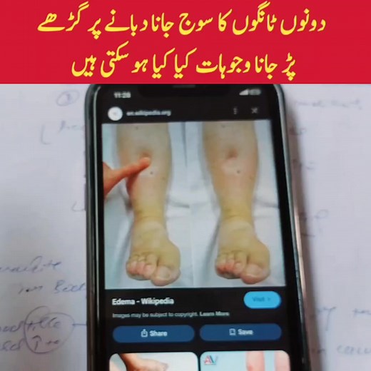 26K views · 198 reactions | Bilateral leg swelling can be caused by various factors, including heart failure, kidney disease, or lymphatic obstruction, requiring medical evaluation. #edema #legsswelling #heartfailure #kidneydisease #liverhealth #lifestyle #obesity | Dr Shahbaz Akhtar | Facebook