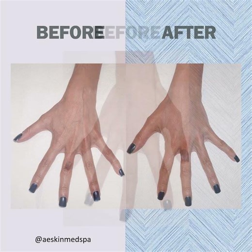 AMAZING results from a Voluma treatment (6)