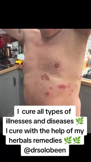 HSV HSV-1 is generally the one that causes herpes on the tongue. But it's also possible to contract an HSV-2 infection in the mouth from sex without a condom or other barrier method. There's currently no cure for either HSV virus, but both can be treated and prevented. #herpes #tongue #clinical #treatment #medicine #medical #diagnosis #drmo #doctor #drsolobeen