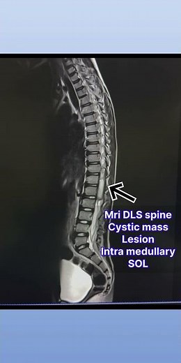 Cystic mass lesion / spine cystic mass / intramedullary SOL / mri spine