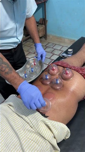 middle back pain treatment cupping