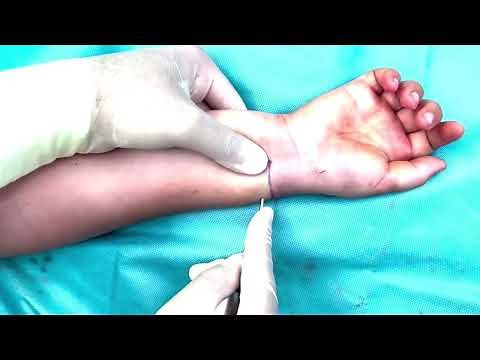 Closed Intramedullary Pinning of Displaced Radial Neck Fracture