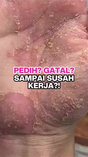 korang klu ada kulit sensitif, bole try sapu krim ni, sebab krim ada moisturizer jugk bole sooth kulit jadi lembut dan kurang gatal2. #oczeplus #eczema #ekzema #kulitsensitif #luka #kulitkering #gatalgatal #eczemaawareness #krim #krimeczema #eczemahealing #eczemarelief #soothingcream #moisturizer #ruam #ruambaby #baby #allergic