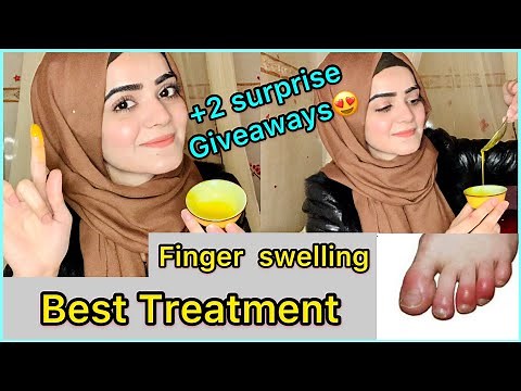 How To Treat Swollen Fingers At Home | Chilblains | Fingers Swelling in Winters | Dietitian Aqsa